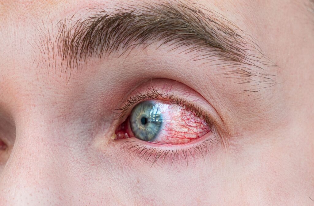 A close-up image of an irritated looking eye, possibly from dry eye or conjunctivitis.