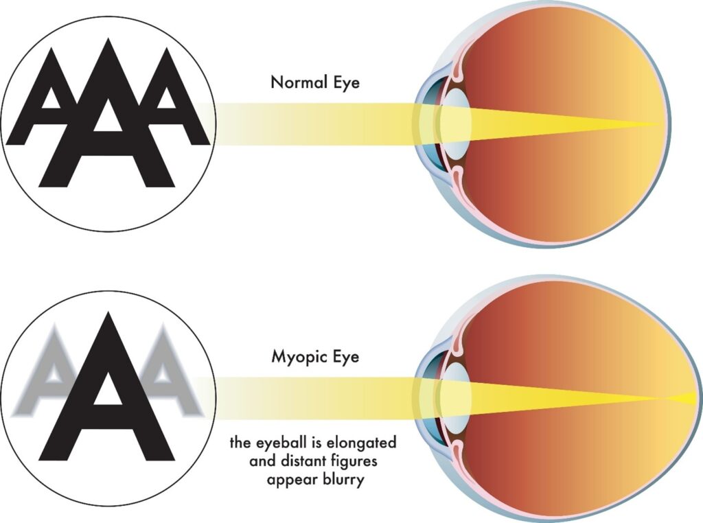 myopia